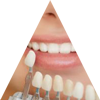 Prothèses dentaires