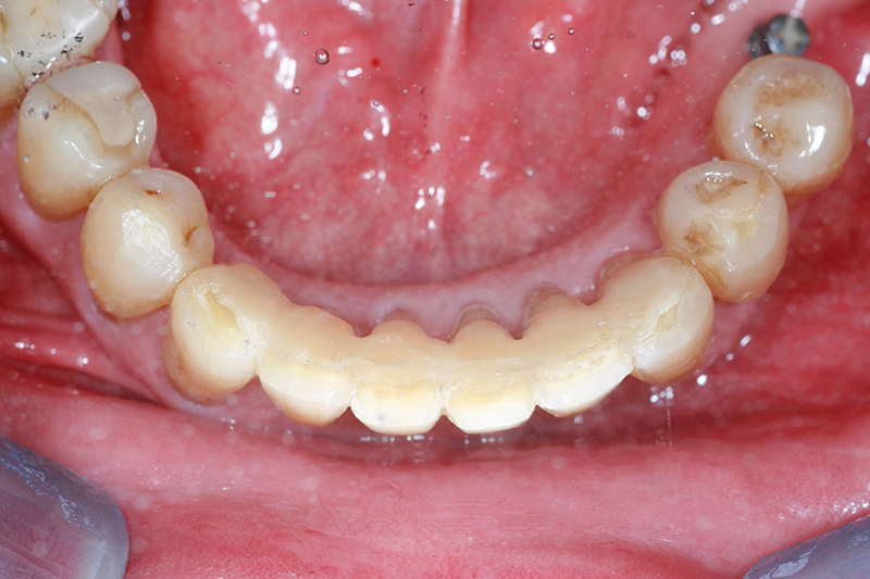 Les contentions orthodontiques Dr Patrick FOURNIER
