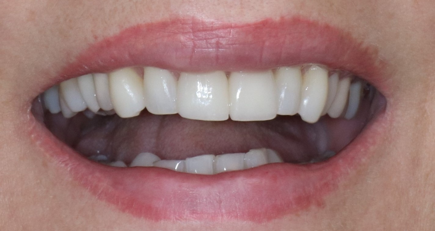 ESTHÉTIQUE ET FONCTION Dr Patrick FOURNIER