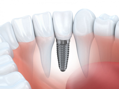 Dr Fournier implantologie dentaire