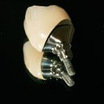 Couronne unitaire sur implant transvissée