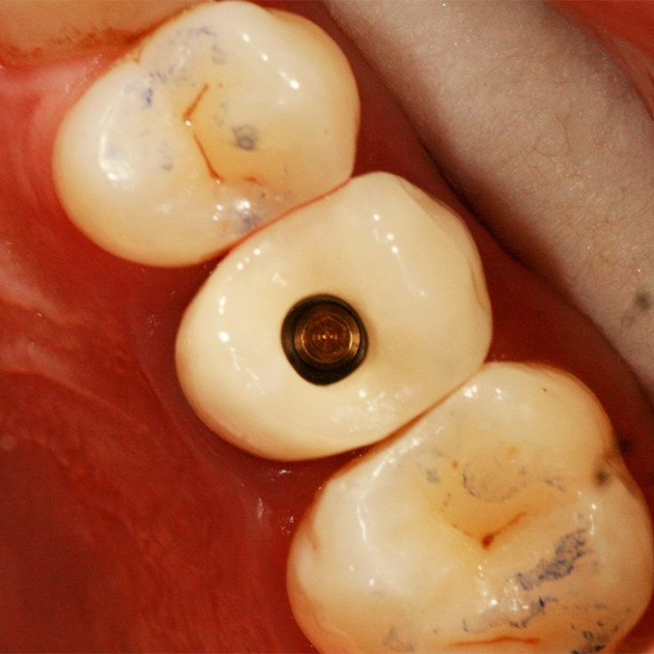 IMPLANTOLOGIE Dr Patrick FOURNIER