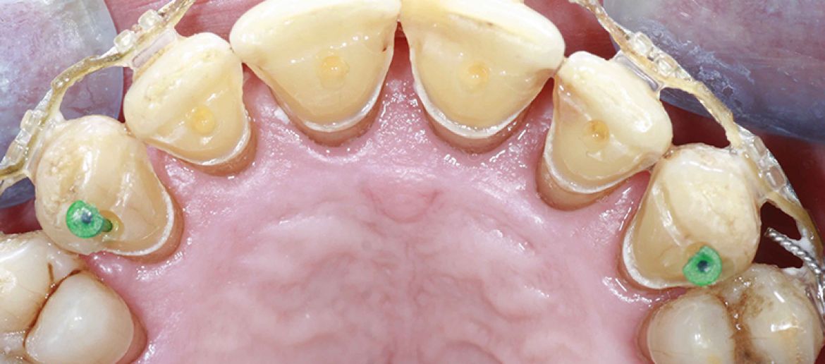 Les contentions orthodontiques